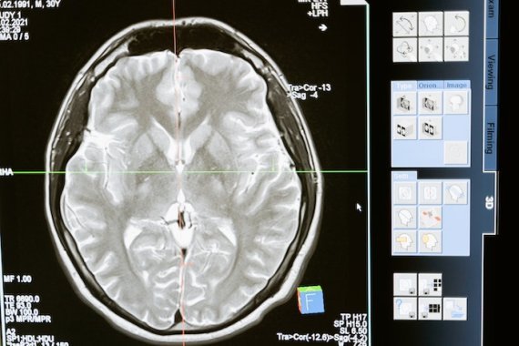 O que é o acidente vascular cerebral: Descubra aqui!